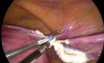 TLH in Bag Fibroid Bag Break