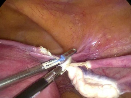 TLH in Bag Fibroid Bag Break