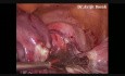 Cervical Fibroid Total Laparoscopic Hysterectomy with Bilateral Salpingo - Oophorectomy by Dr.Avijit Basak