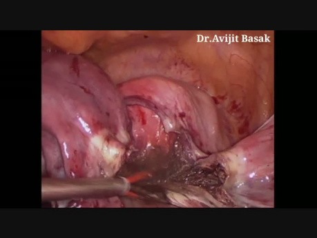 Cervical Fibroid Total Laparoscopic Hysterectomy with Bilateral Salpingo - Oophorectomy by Dr.Avijit Basak