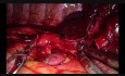 Complex Uniportal VATS Left Upper Sleeve Reconstruction After Chemoradiation