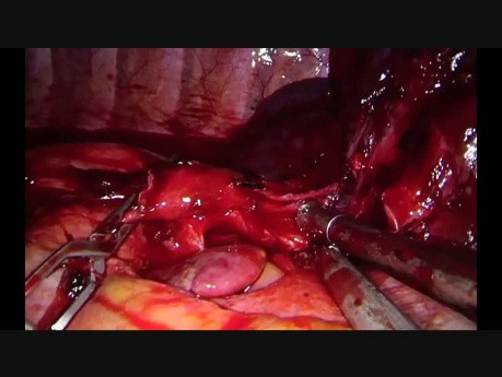Complex Uniportal VATS Left Upper Sleeve Reconstruction After Chemoradiation