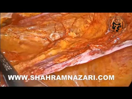 Laparoscopic Repair of a Missed Direct Hernia