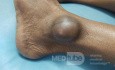 Suspected Dermoid Cyst on Lateral Malleolus of Left Leg 