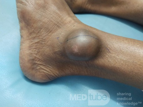 Suspected Dermoid Cyst on Lateral Malleolus of Left Leg 