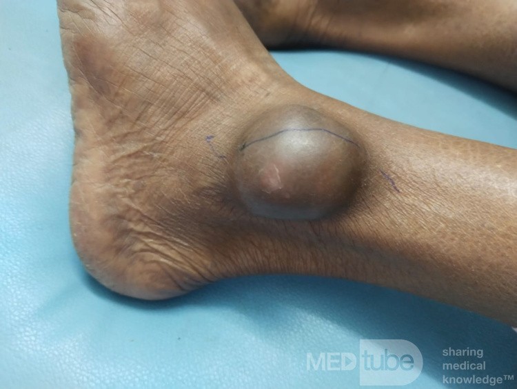 Suspected Dermoid Cyst on Lateral Malleolus of Left Leg 