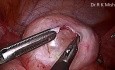 Dermoid Cystectomy by Laparoscopy