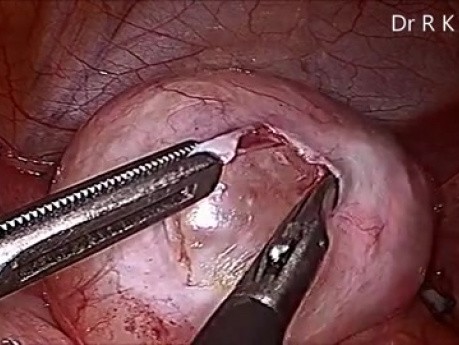 Dermoid Cystectomy by Laparoscopy