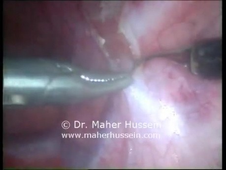 Thorascopic Sympathectomy
