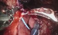 Robot Assisted 3D Models-guided Ureteral Reimplantation