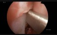 Endoscopic Septoplasty and Resection of Some Polyps