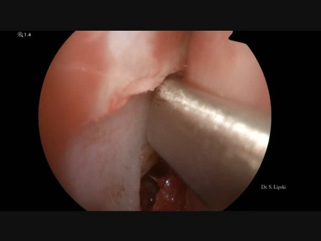 Endoscopic Septoplasty and Resection of Some Polyps