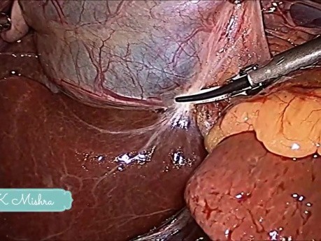 Standard Laparoscopic Cholecystectomy