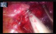 Live Surgery from Hong Kong Non-intubated Uniportal VATS Upper Lobectomy