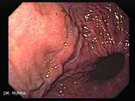 Esophageal Varices and Hiatus Hernia - the Closer Look at Hernia