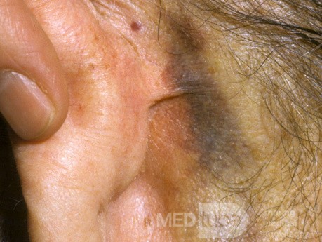 Temporal Bone Fracture [Battle's sign]