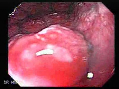 Scirrhous Gastric Carcinoma - Endoscopy (4 of 15)