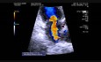 Role of Chordae Tendineae in Mitral Regurgitation