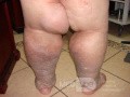 Elephantiasis nostras verrucosa on the legs with morbid
 obesity (1 of 5)