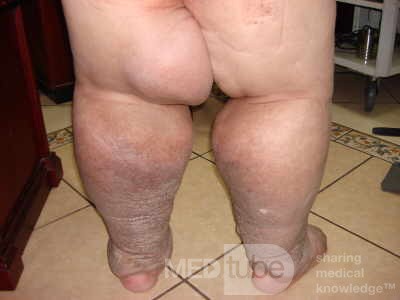 Elephantiasis nostras verrucosa on the legs with morbid
 obesity (1 of 5)