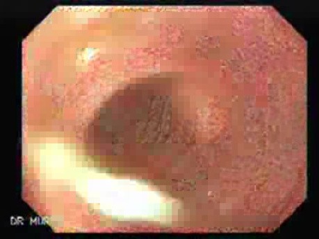 Adenocarcinoma of the cardias (5 of 14)