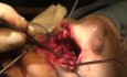 Superior Rhinotomy - Olfactory Neuroblastoma