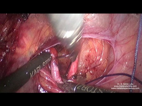 Anterior Dissection and Ligation of Uterine Artery at Its Origin in a Large Uterus