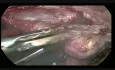 Nine Time Laprotomy Done and Pts Come for TLH.....TLH Done But Most Complicated TLH Up Till Now