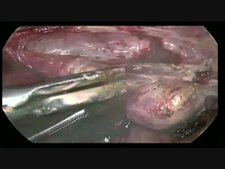 Nine Time Laprotomy Done and Pts Come for TLH.....TLH Done But Most Complicated TLH Up Till Now