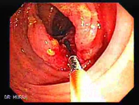 Ascending Colon Cancer (4 of 6)