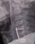 Cloward's Anterior Approach for AO Spine Type C Cervical Fracture with Brown Sequard Syndrome