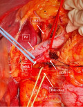 Hepatic Artery Behind Portal Vein