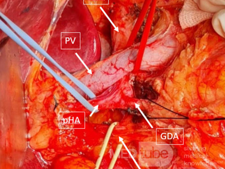 Hepatic Artery Behind Portal Vein