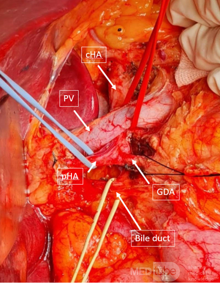 Hepatic Artery Behind Portal Vein