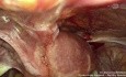 Surgery for Isthmocele After Cesarean Section