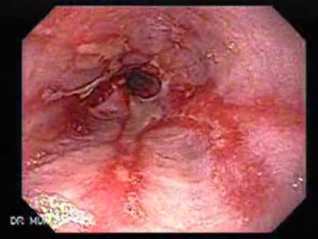 Esophageal Stricture Due To Reflux Esophagitis - Close-Up