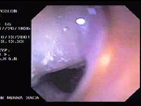 Adenocarcinoma of the Transverse Colon (1 of 2)