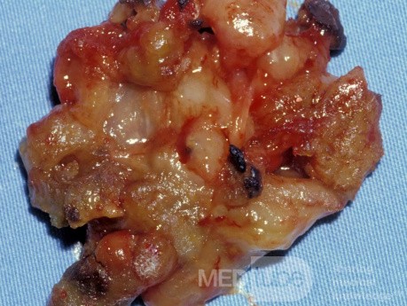 Allergic Fungal Sinusitis [contents of the maxillary sinuses]