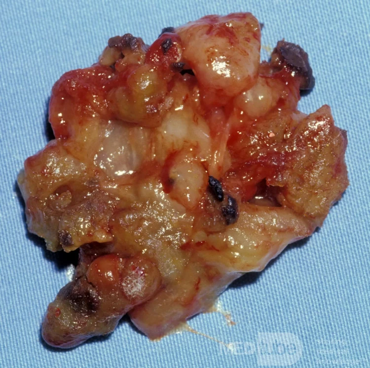 Allergic Fungal Sinusitis [contents of the maxillary sinuses]