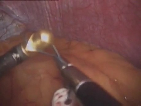 Laparoscopic Gastric Band 