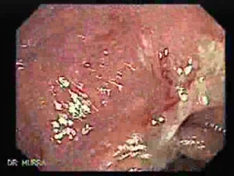 Ulcerative Colitis Complicating Colon Cancer (2 of 4)