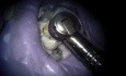 Maxillary Molar Endo Access - Table Top Microscope