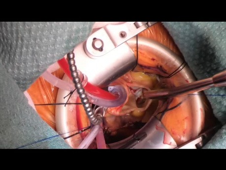Minimally Invasive Aortic Valve Replacement for Severe Aortic Stenosis