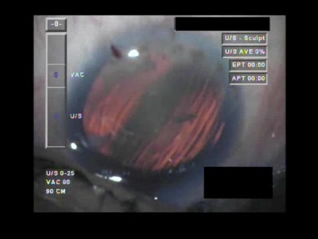 Cataract Surgery V - Part 1