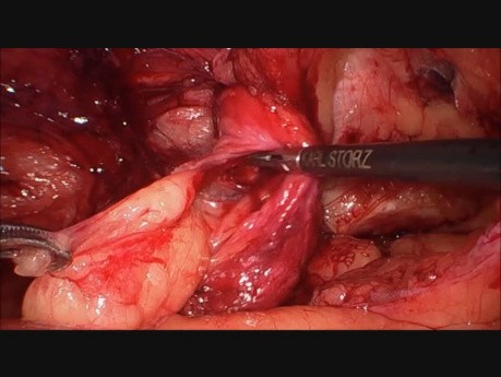 Re-operation After TAPP Due to Hematoma on 7th Day (Inguinoscrotal Hernia) 
