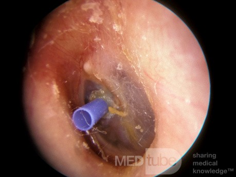 Blue Silastic Ventilation Tube [T-Tube]