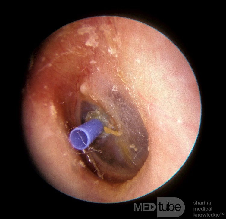 Blue Silastic Ventilation Tube [T-Tube]