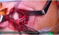 Osteosynthesis of the Mandiblar Condyle at the Base Using an Additional Reinforcement Site