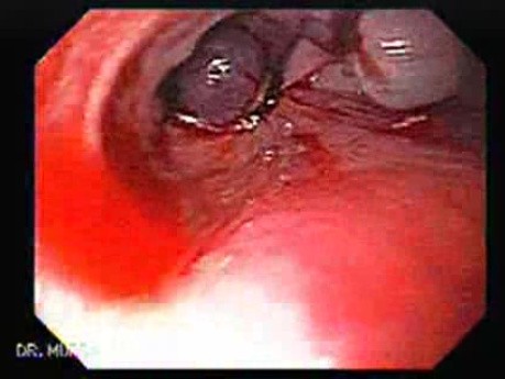 Esophageal Varix -  Endoscopic Image of Ligation of Esophageal Varices