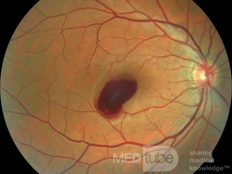 Preretinal Hemorrhage in 38 years old Patient During Sneezing